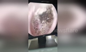Man has hundreds of ‘mushrooms’ growing inside his ear