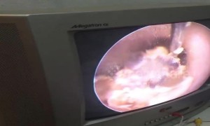 Doctor removes 15 years' worth of gunk from woman's clogged ear