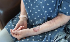 Grandmother gets new tongue fashioned from arm flesh after cancer treatment