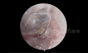 Tiny spider found building a nest in man’s ear in China in stomach-churning clip