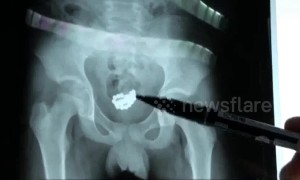 Chinese teen boy has 29 magnetic beads removed from bladder