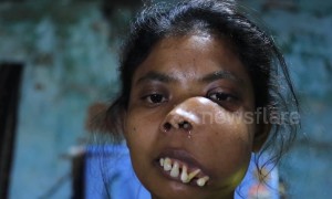 Indian woman with facial tumour branded 'monkey girl' launches crowdfunding campaign for surgery