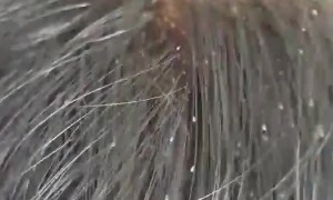 Lots and Lots of Lice