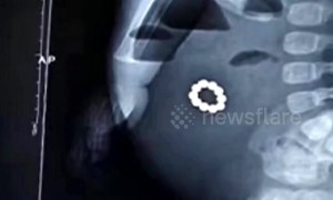 Doctor removes 10 magnetic balls from toddler's gut in China's Zibo