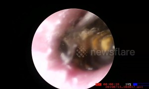 Doctor in Vietnam removes bee that was burrowing in man's ear