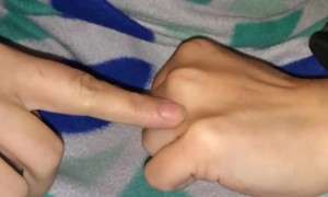 Woman Displays Her Unique Medical Disorder