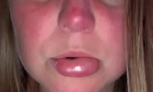 Medicine Side Effects Lead to Extreme Swelling