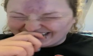 Rubber Shot Glass Bruises Forehead