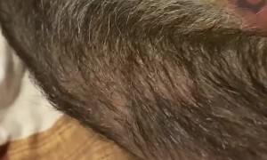 Hairy Birthmark Gives Man With Unique Look