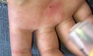 Simple Trick to Suck Out Splinters