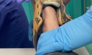 Nail Removed From Foot After Nail Gun Accident