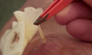 Removing a Larva That Grew in my Leg for 5 Weeks