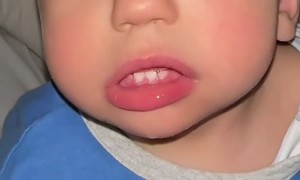 Child Shows Off Blue Brown Heterochromia