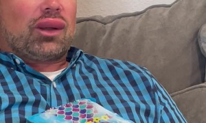 Husband Stung by a Wasp on His Lip