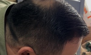 Top Spins On Balding Head
