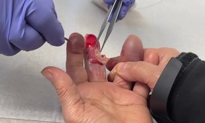 Woman Receives Treatment for Severe Frostbite