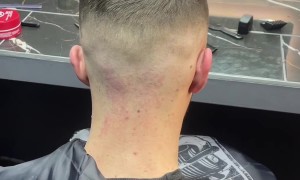 Applyng Alcohol to Avoid Irritation