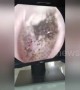 Man has hundreds of ‘mushrooms’ growing inside his ear