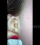 No a-CYST-ance needed for US woman while she drains her abscessed ear
