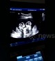 Identical twin sisters spotted 'fighting' in womb during ultrasound in China