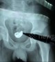 Chinese teen boy has 29 magnetic beads removed from bladder