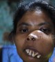 Indian woman with facial tumour branded 'monkey girl' launches crowdfunding campaign for surgery