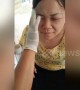 Dozens of parasitic worms removed from Vietnamese woman's face