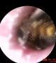 Doctor in Vietnam removes bee that was burrowing in man's ear