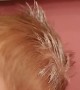 Toddler Unknowingly Puts Rash Cream In Hair