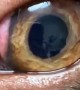Parasitic Worms Spotted in Dog's Eye