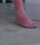 That's a Bad Sunburn