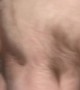 Baby's Body Hair After BMT Transplant